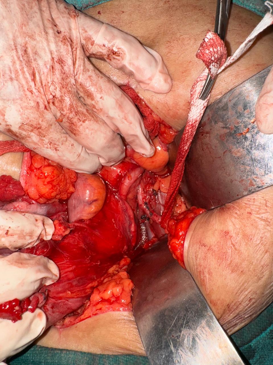 Anjula Bhargava - Successful Treatment of Endometrial Carcinoma